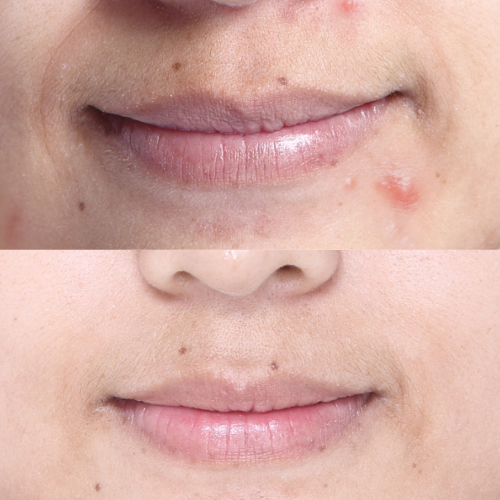 [Crema facial para acné] SOMEBYMI AHA BHA PHA 30 Days Miracle Cream 60ml