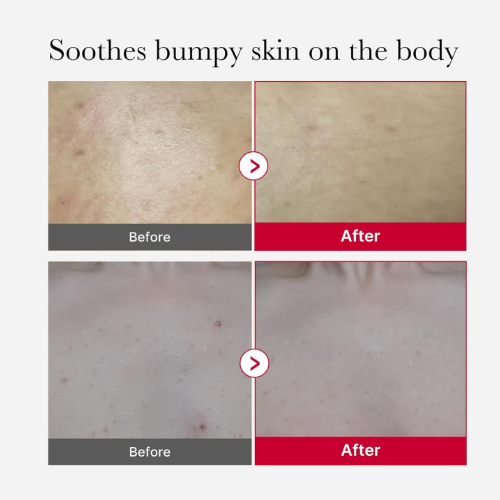 [Exfoliante corporal en spray] Medicube Red Acne Body Peeling Shot 2.0 110ml